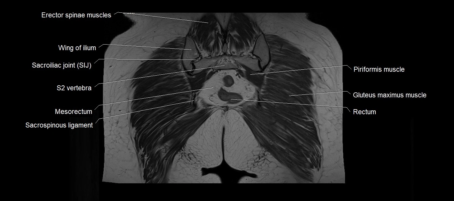 MRI 3T pelvis coronal cross section anatomy image 24.webp